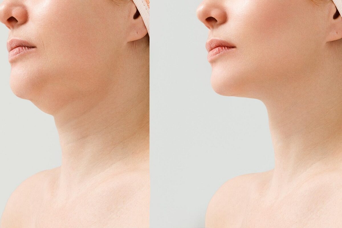 اندولیفت غبغب در اصفهان💖 ؛ مزایا، مراقبتها و هزینه 1404 هزینه اندولیفت غبغب در اصفهان