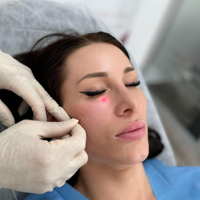 لیزر اندولیفت زیر چشم در اصفهان👁️ (+مزایا و هزینه 1404) جوانسازی زیر چشم با لیزر در اصفهان