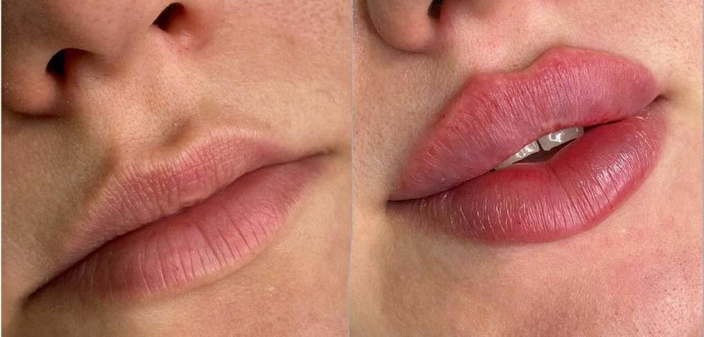 هزینه تزریق ژل لب روسی در اصفهان
