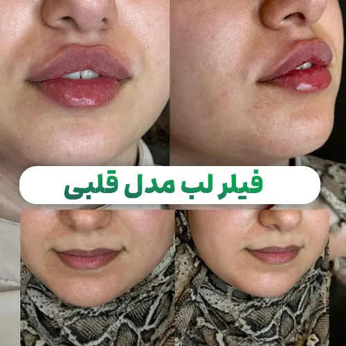 تزریق ژل لب در اصفهان (+قیمت 1404) و نمونه کار تزریق ژل لب مدل قلبی در اصفهان