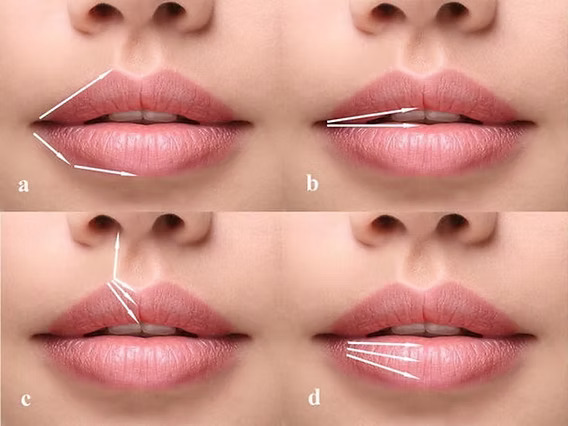 تزریق ژل لب مدل روسی در اصفهان