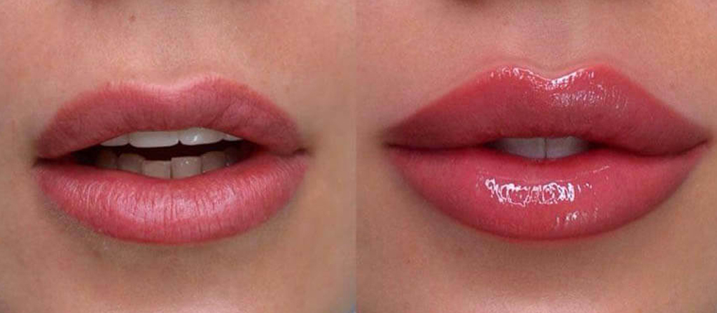 کلینیک تزریق ژل لب روسی در اصفهان