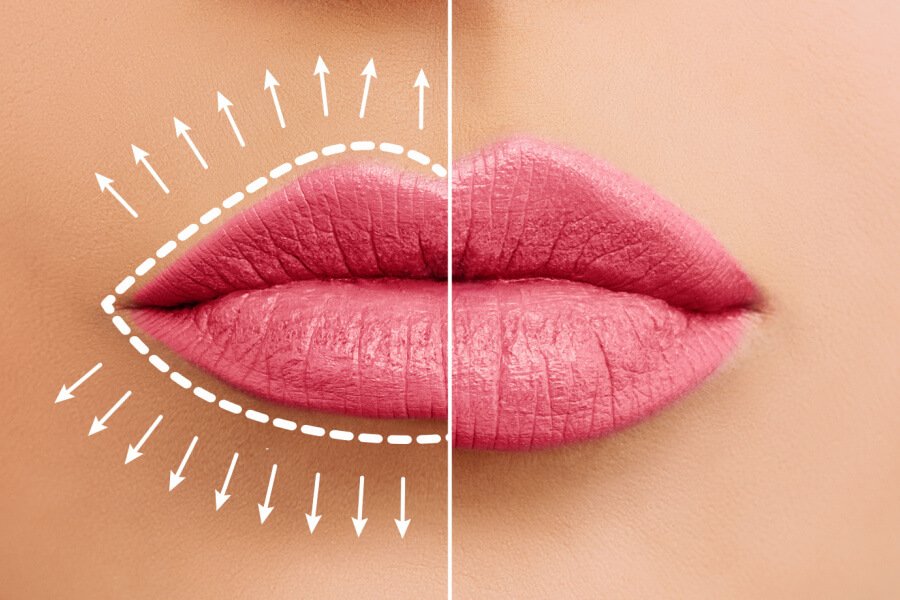 تزریق ژل لب مدل روسی در اصفهان