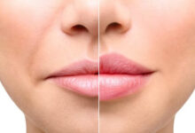 تزریق ژل لب روسی در اصفهان