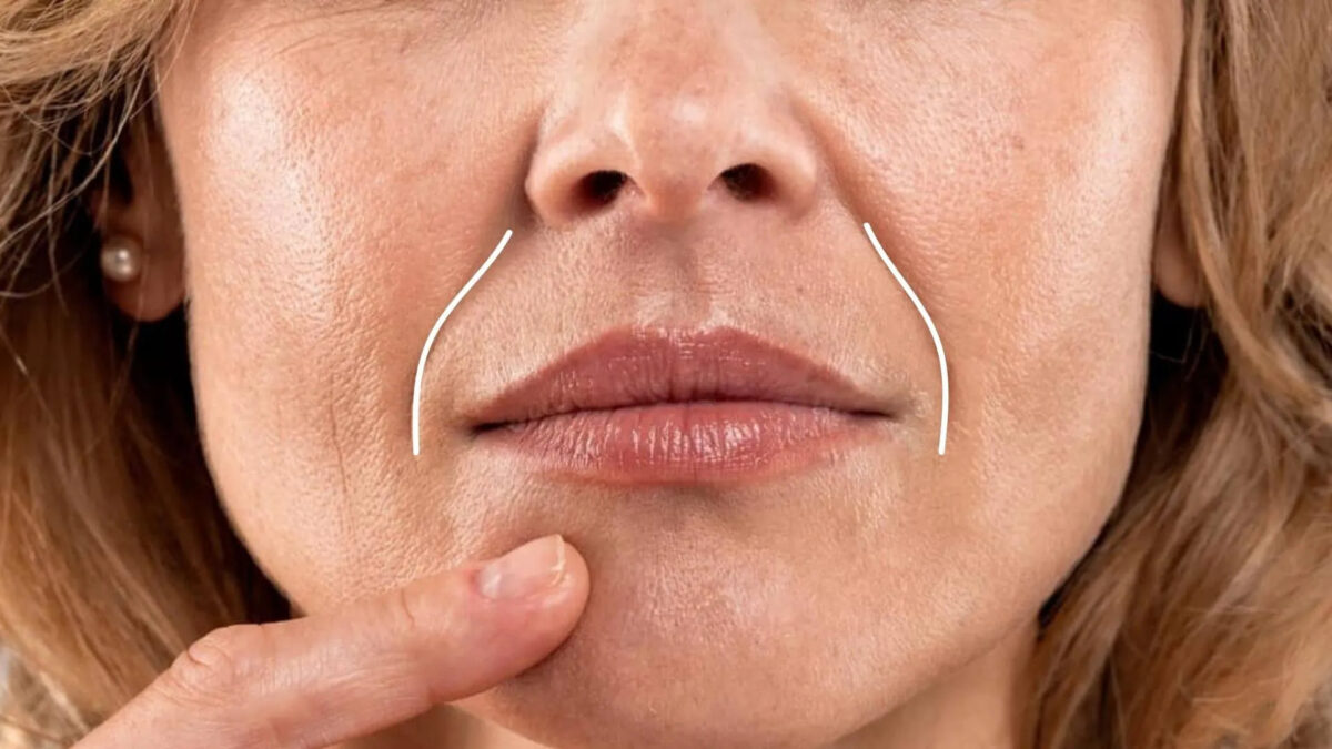 تزریق فیلر خط خنده در اصفهان😀 ؛ مزایا، مراحل و قیمت 1405 بهترین کلینیک فیلر خط خنده در اصفهان