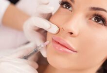 تزریق فیلر خط خنده در اصفهان