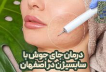 درمان جای جوش با سابسیژن در اصفهان