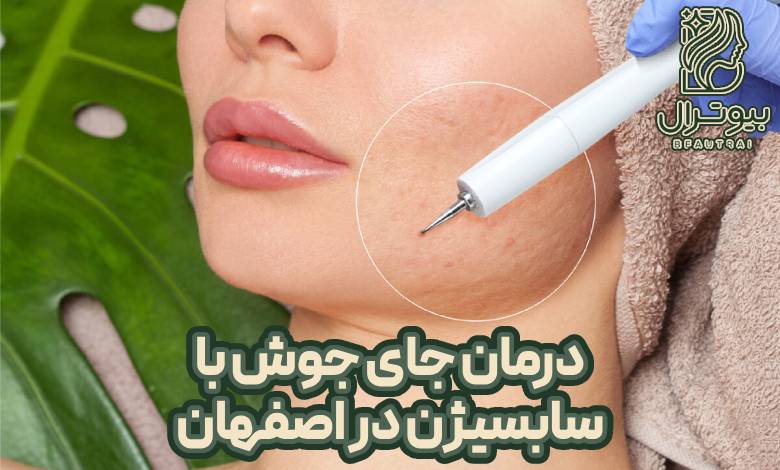 سابسیژن در اصفهان: درمان جای جوش و اسکار (+هزینه 1404) درمان جای جوش با سابسیژن در اصفهان