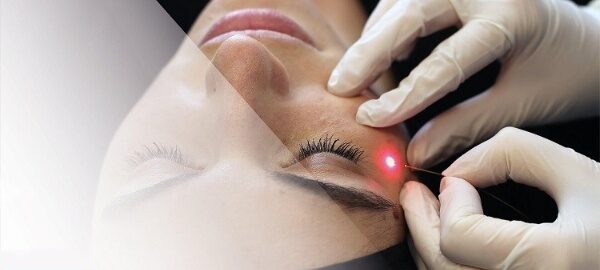 لیزر اندولیفت زیر چشم در اصفهان👁️ (+مزایا و هزینه 1404) لیزر اندولیفت زیر چشم در اصفهان