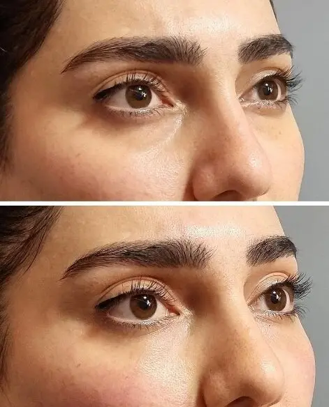 تزریق فیلر زیر چشم در اصفهان