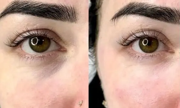 رفع سیاهی زیر چشم در اصفهان