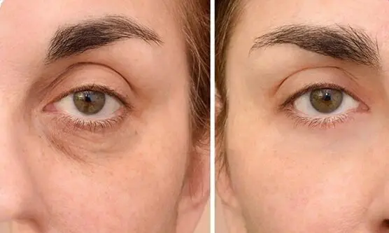 تزریق فیلر برای گودی زیر چشم در اصفهان