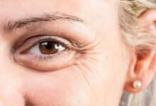 تزریق بوتاکس پنجه کلاغی در اصفهان