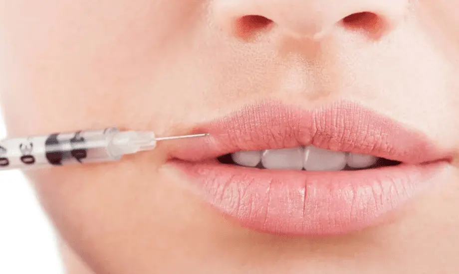 فیلر لب طبیعی در اصفهان با نتیجه ظریف و نچرال