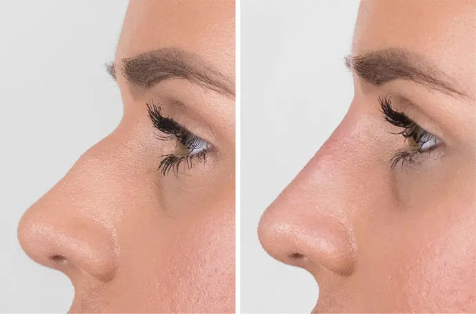 تزریق ژل بینی در اصفهان