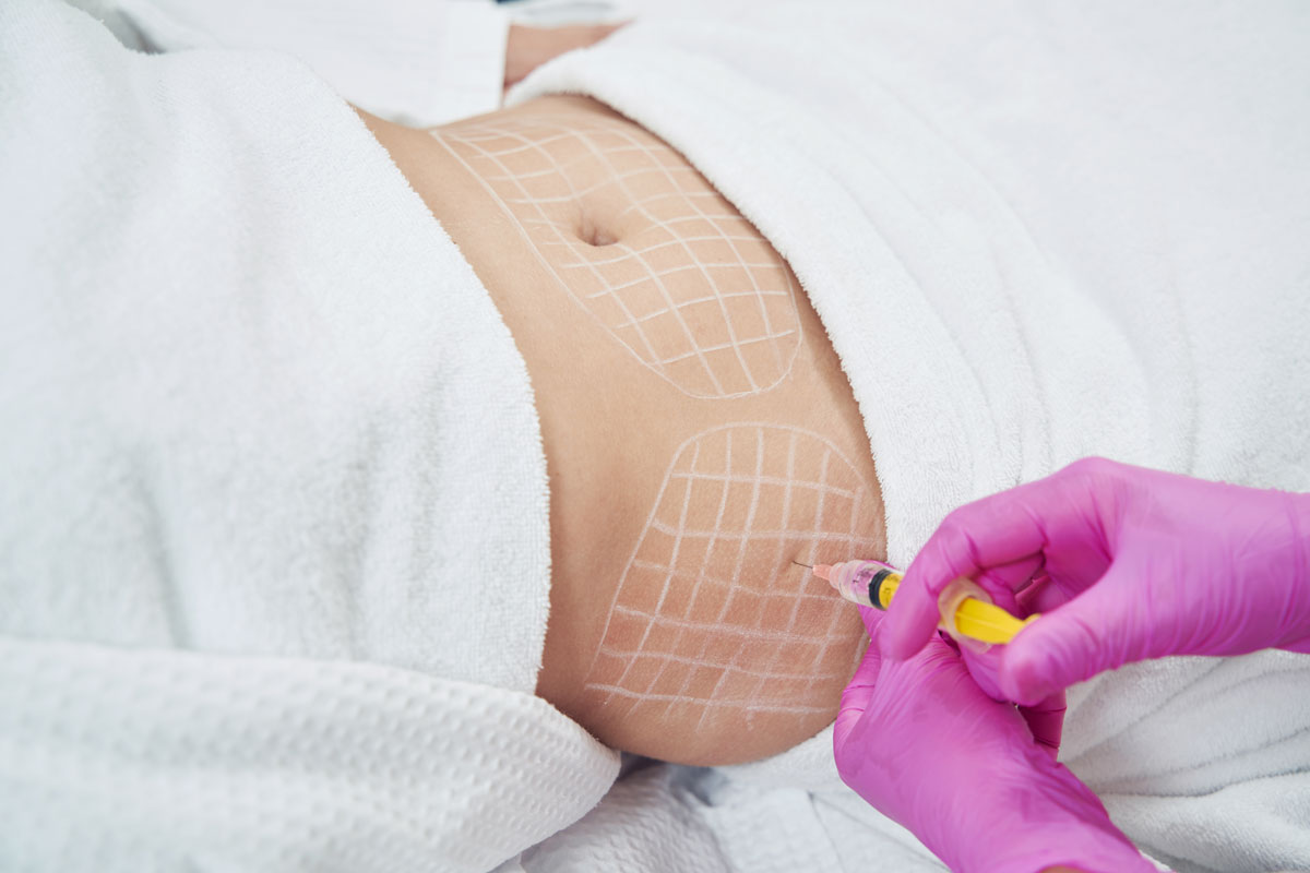 مزوتراپی لاغری شکم و پهلو در اصفهان
