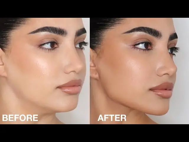 تزریق فیلر زاویه فک در اصفهان🗿 (1405) جوانی چهره با مادلینگ💎 فیلر کانتورینگ صورت در اصفهان
