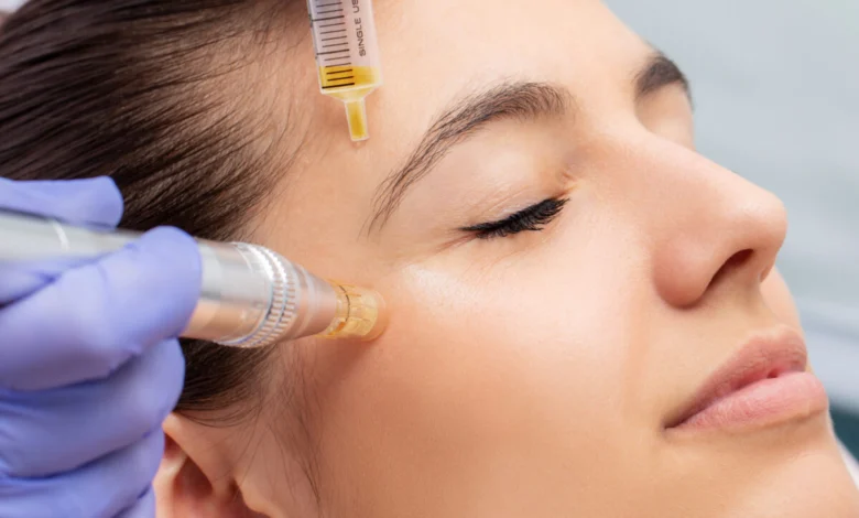 مزونیدلینگ صورت در اصفهان برای جوانسازی پوست