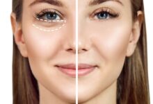 تزریق مزوژل زیر چشم در اصفهان