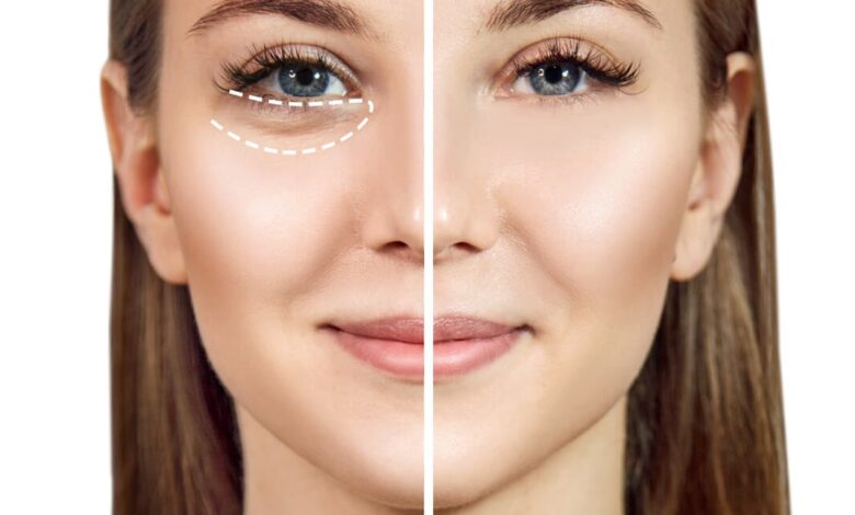 تزریق مزوژل زیر چشم در اصفهان (+هزینه 1404) راه حلی فوری؟ تزریق مزوژل زیر چشم در اصفهان