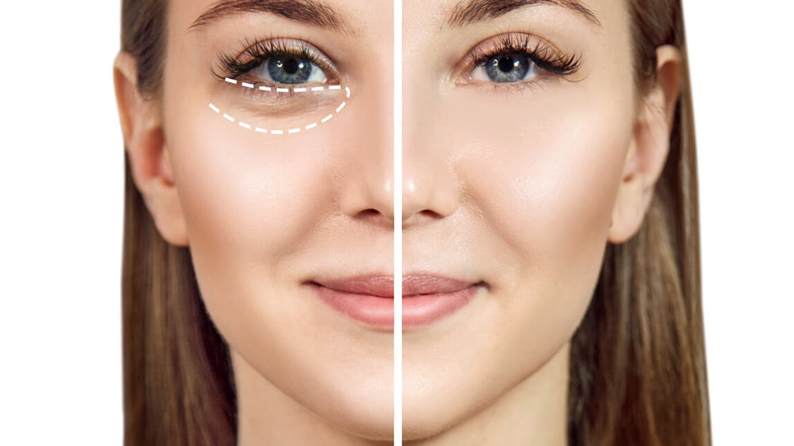 تزریق مزوژل زیر چشم در اصفهان