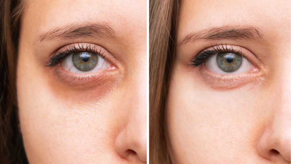 تزریق مزوژل زیر چشم در اصفهان👀 (+هزینه 1404) راه حلی فوری؟ تزریق مزوژل زیر چشم در اصفهان