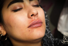 قیمت تزریق ژل لب در اصفهان در کلینیک بیوترال