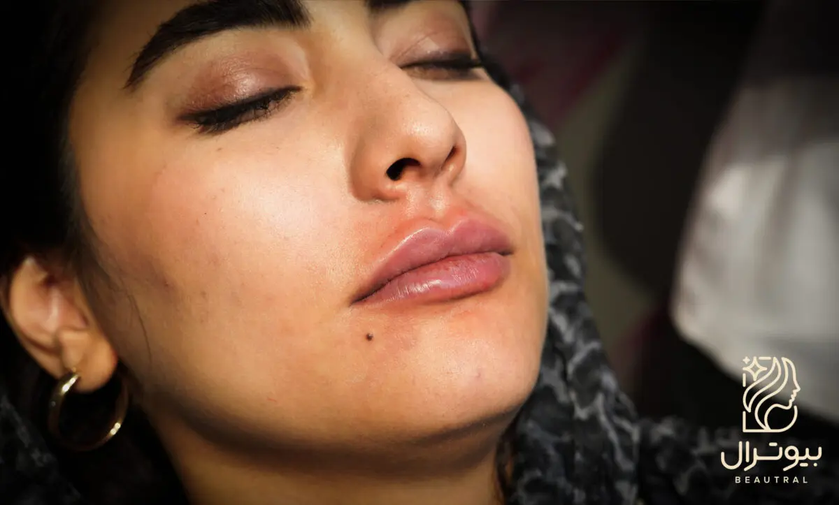 فیلر لب در اصفهان با انتخاب فرم و محصول متناسب