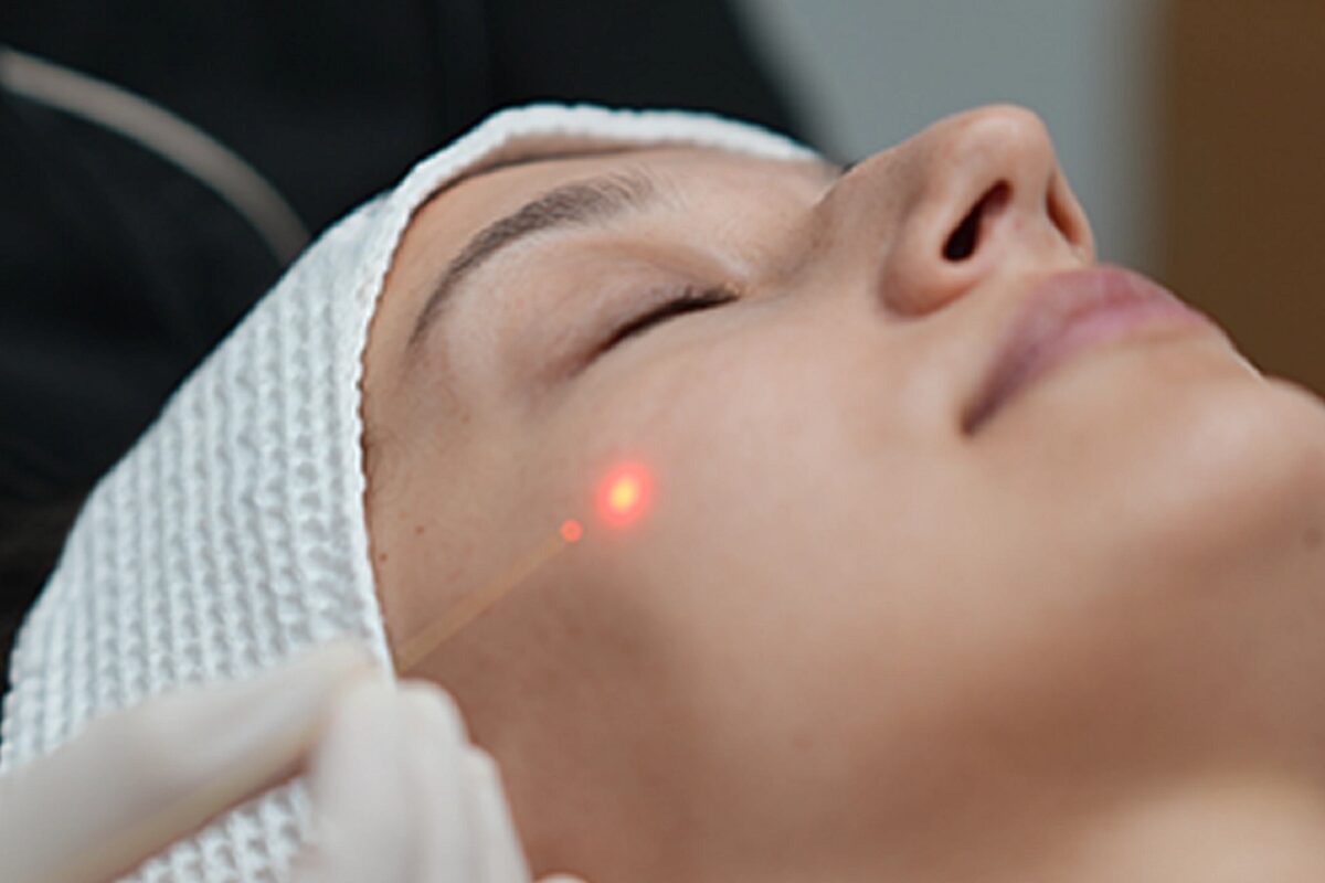 اندولیفت در اصفهان؛💖 مقایسه، مراحل و ماندگاری (+هزینه 1404) قیمت اندولیفت در اصفهان و عوامل موثر روی آن