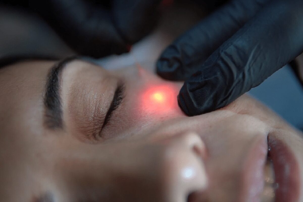 اندولیفت در اصفهان؛💖 مقایسه، مراحل و ماندگاری (+هزینه 1404) مراحل و کاندیدای مناسب اندولیفت در اصفهان