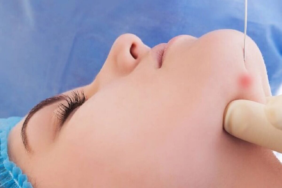 اندولیفت در اصفهان؛💖 مقایسه، مراحل و ماندگاری (+هزینه 1404) کاربردهای اندولیفت و نقش آن در جوانسازی