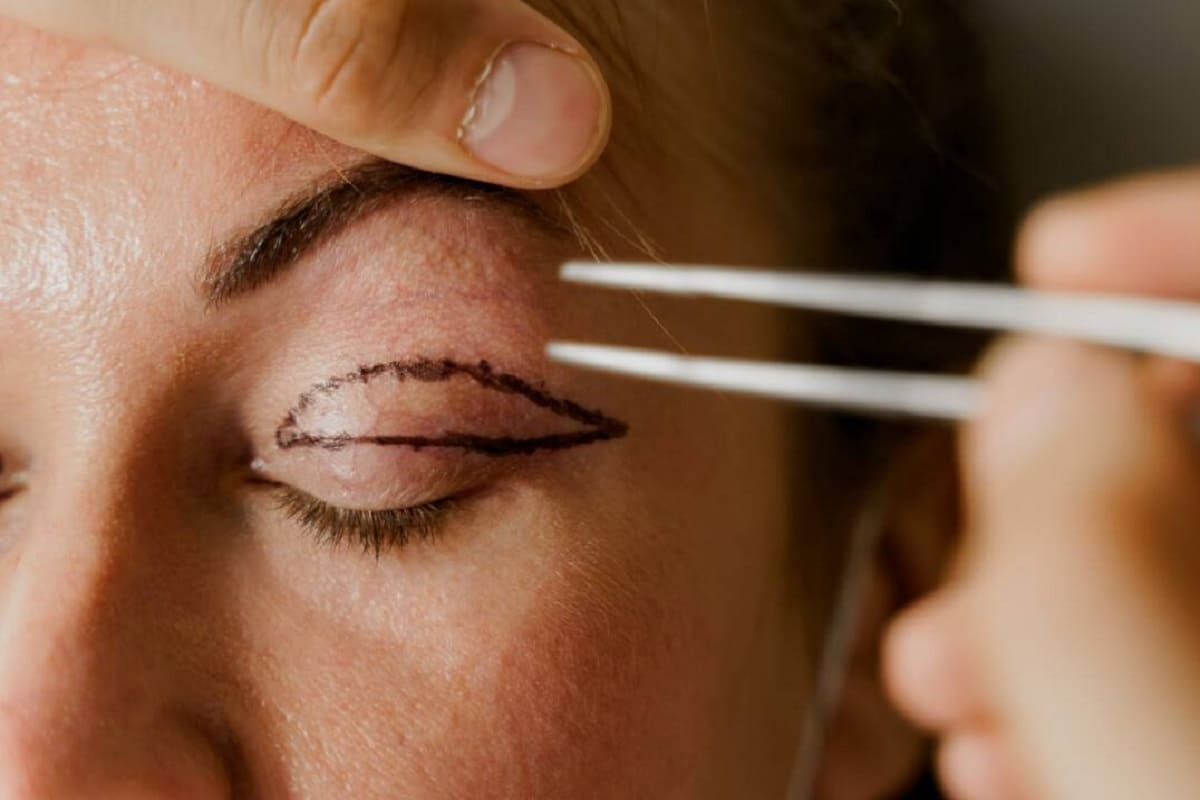 مراقبت های قبل و بعد از جراحی بلفاروپلاستی در اصفهان