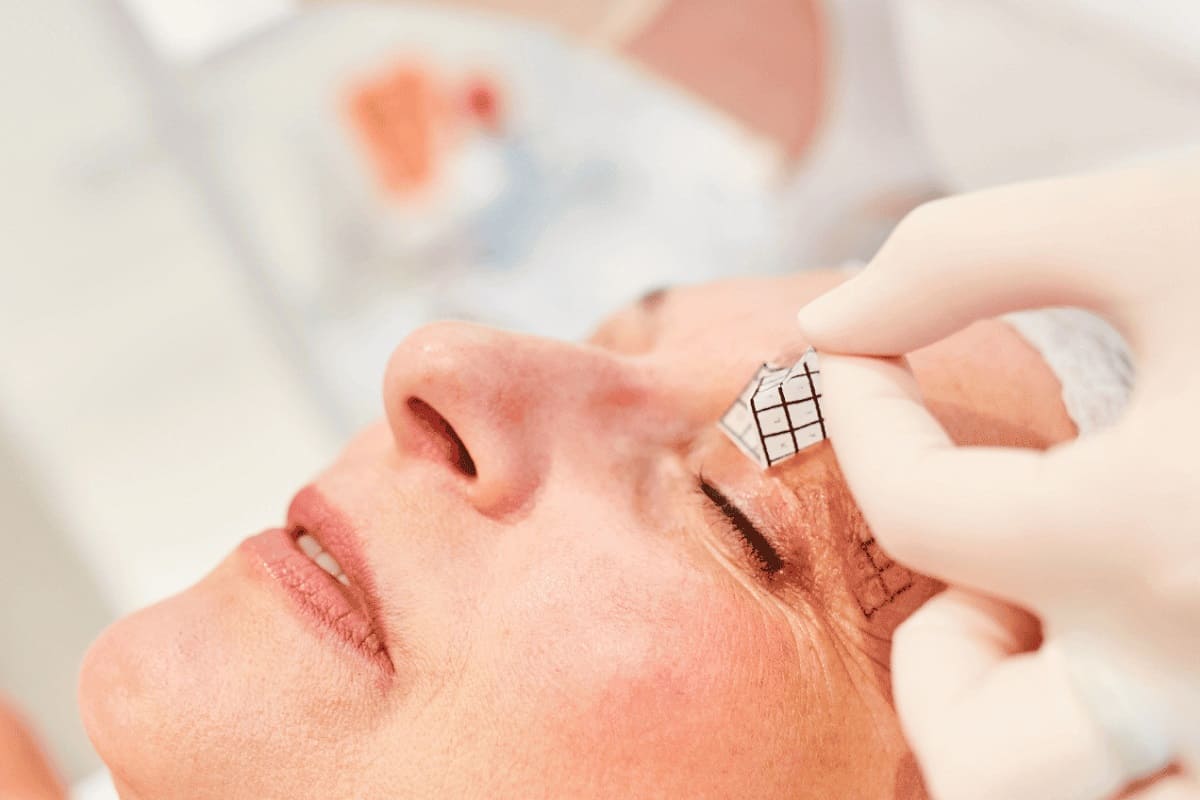 هزینه انجام بلفاروپلاستی در اصفهان